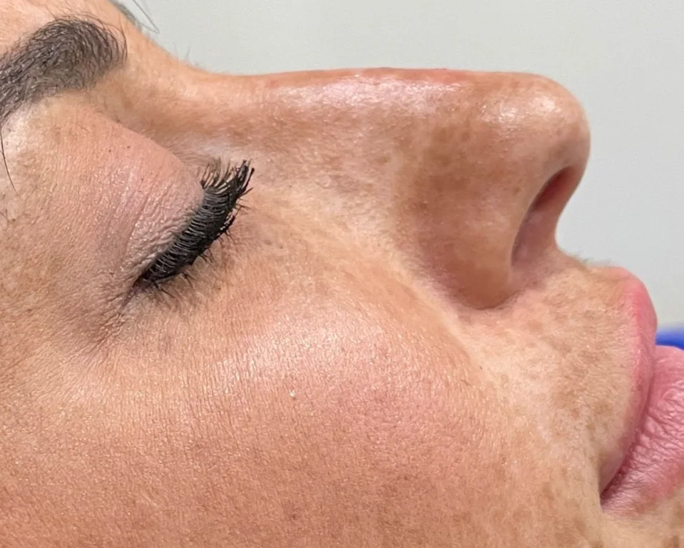 The Future of Non-Surgical Cosmetic Treatments in Canada